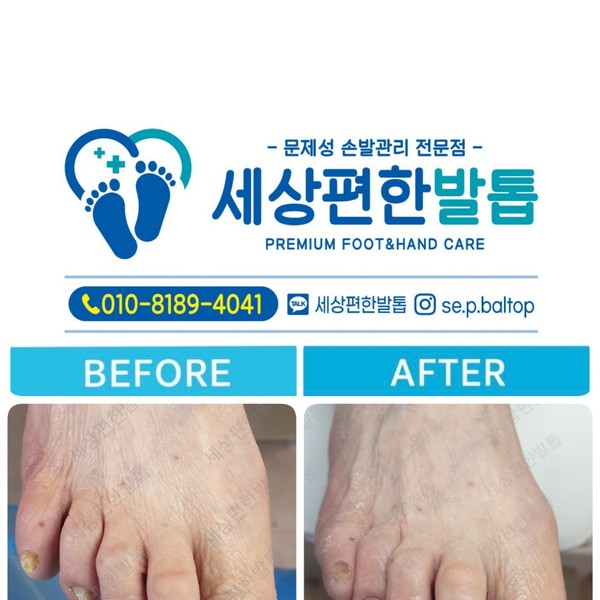 [전남 광양] 세상편한발톱 체험단