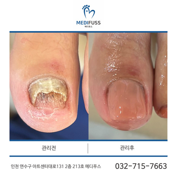 [인천 연수구] 메디푸스 체험단