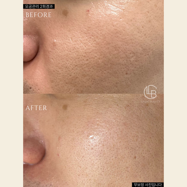 [서울 은평구] 라운뷰티 체험단